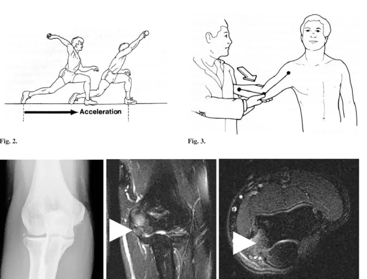 Fig. 5. Reconstruction of ulnar collateral ligament (Modified and redrawn from The elbow and its disorders by morrey).