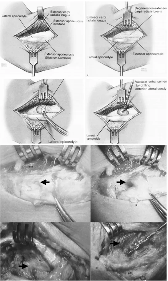 Fig. 8. 외 상과염의 관혈적 수술 방법으로 단 요 수근 신전근의 퇴행성 기시부를 제거하고 상완골의 외상과 부위를 천공한 다(Modified and redrawn from Master techniques in orthopaedic surgeon the elbow by morrey).