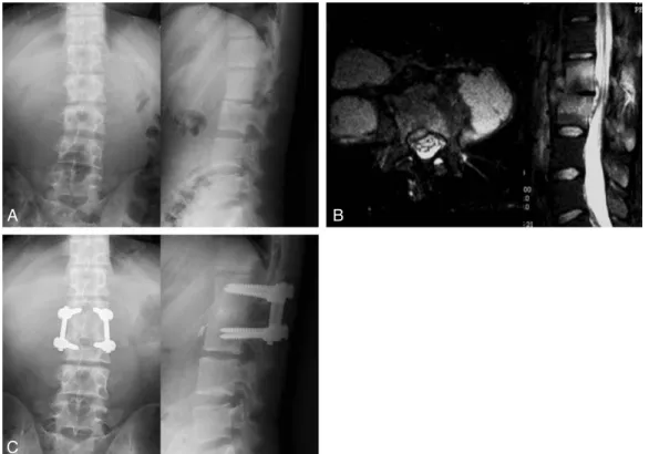Fig. 1. A 21 year-old man developed an L2-3 tuberculous spondylitis with psoas abscesses at both sides (case 1)