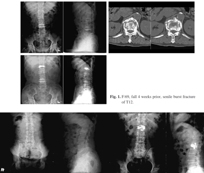 Fig. 1. F/69, fall 4 weeks prior, senile burst fracture of T12.