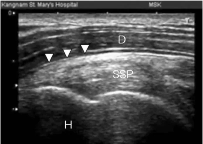 Fig. 4. Sonographic image of posterior shoulder joint shows long axis view of infraspinatus