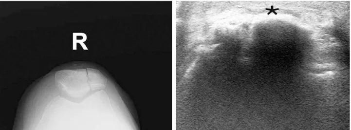 Fig. 14. Pretibial bursitis of the right knee of the 48 years old female. Arthroscopic bursectomy was performed and the inflammation was completely cured in 6 months after the surgery.