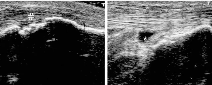 Fig 16. Baker ’ s cyst consists of three portion, the base, neck and body as shown in axial view (A) sagittal view (B) of the MRI and short axis (C) and long axis (D) of the sonography