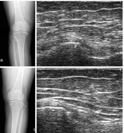 Fig. 17. Osteochondroma of the medial side of the proximal tibia of both knee in a 65 years old female