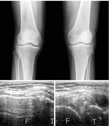 Fig. 19. Medial meniscal calcification. The x-rays show calcification of both medial and lateral menisci