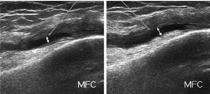 Fig. 2. Effusion of suprapatellar pouch noted at medial aspect of the pouch. The amount of fluid is increased with squeezing of lateral gutter.