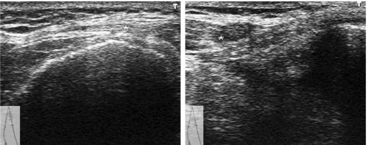 Fig. 8. The long (left) and short (short) axis echotecture of the common peroneal nerve