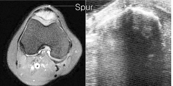 Fig. 10. Detection of the source of tenderness on the patella with sonography. The small spur with extreme tender- tender-ness could not be appreciated with x-rays or MRI