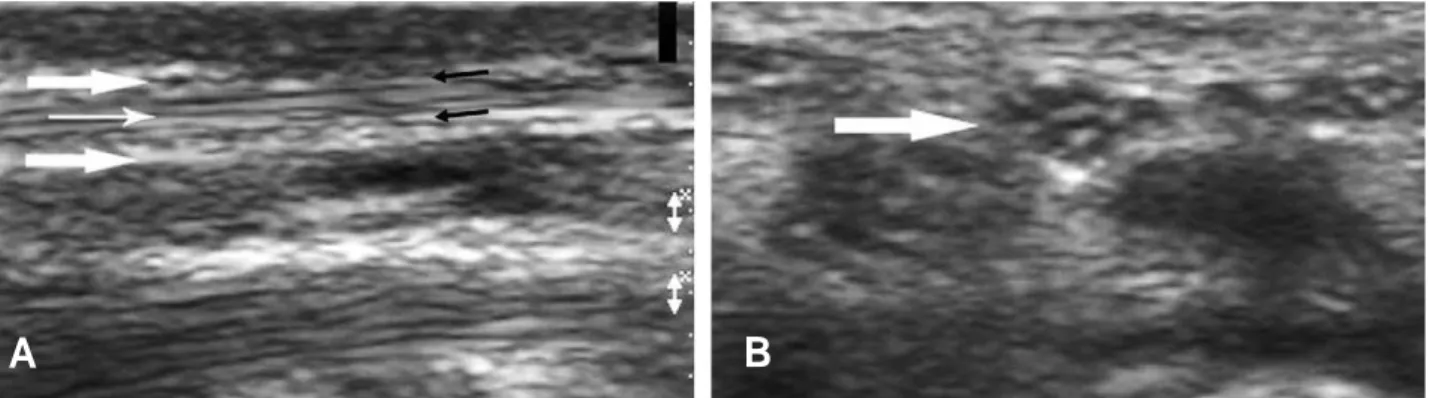 Fig. 1. Long axis image (A) of normal median nerve confined with thick external epineurium (thick white allows) shows clear delineation of fascicular arrangement
