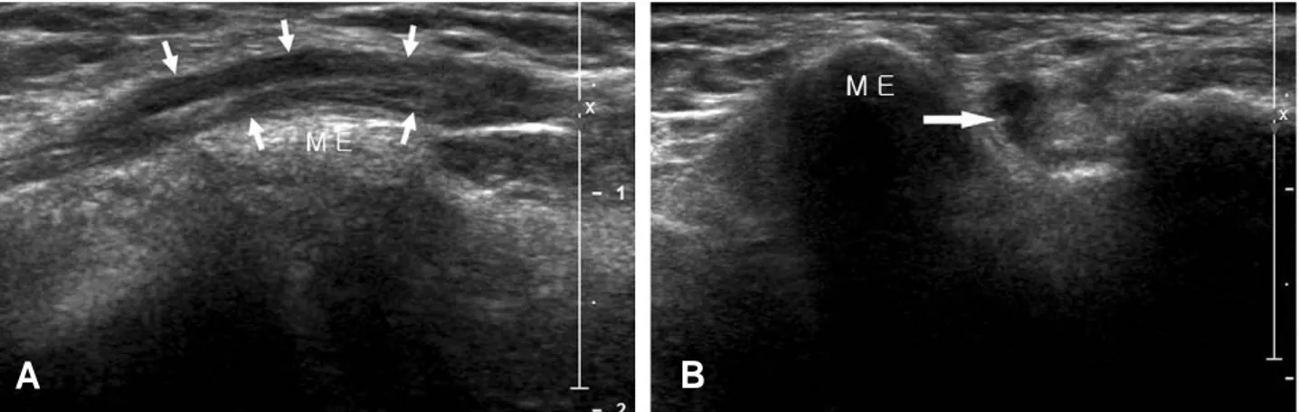 Fig. 3. Long axis (A) and short axis (B) images of cubital tunneI in a patient with ulnar neuropathy reveal a swollen hypoechoic unlar nerve (white allows) with loss of fascicular pattern, which are compatible with cubital  tun-nel syndrome (ME: medial epi