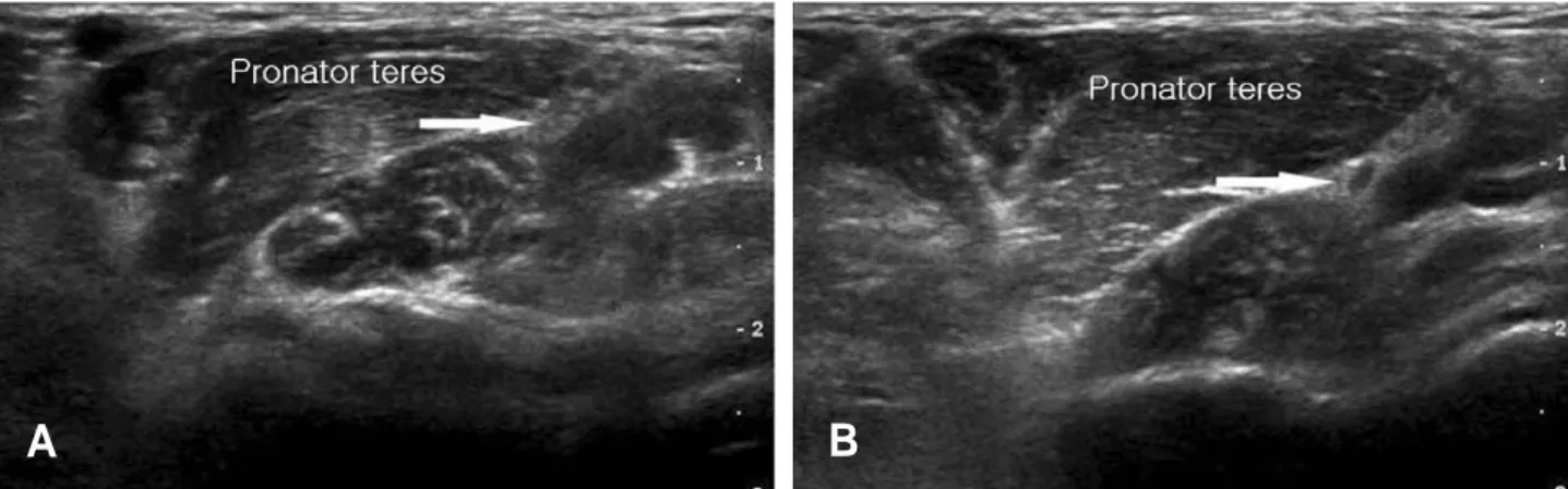 Fig. 4. Images in a patient with pronator teres syndrome, the median nerve image (white allow) shows much decreased size on active resistive pronation of forearm (A: on relaxation, B: on active resistive pronation).