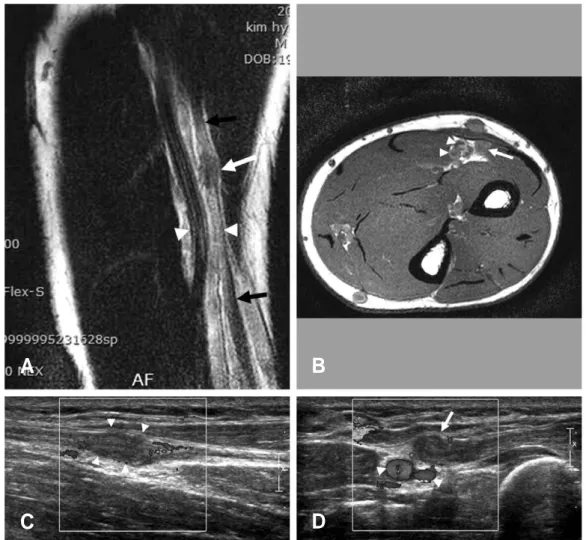 Fig. 5. MR and ultrasonographic images of a patient with radial sensory neuropathy. It was hard to find the lesion in MRI (A,  B) initially (white allow: mass, black allows: superficial radial nerve, white allow heads: radial artery and its accompanied vei