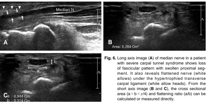 Fig. 6. Long axis image (A) of median nerve in a patient with severe carpal tunnel syndrome shows loss of fascicular pattern with swollen proximal  seg-ment