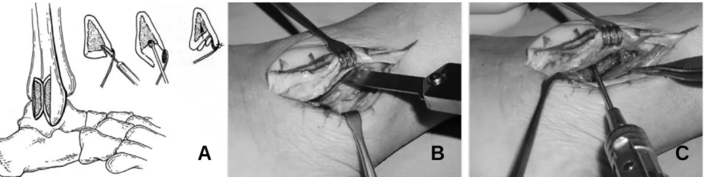Fig. 2. (A) Schematic diagram showed the surgical stages of the fibular groove deepening procedure for the recur- recur-rent peroneal tendon dislocation