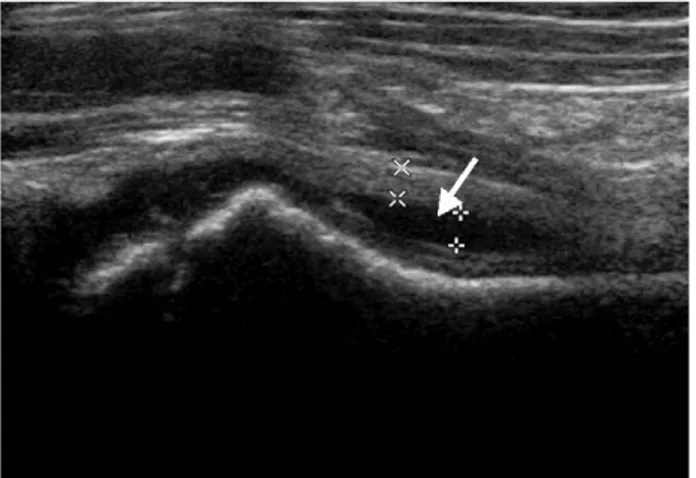Fig. 3. 47 year old male complained painful swelling of right proximal thigh after strenuous activity.