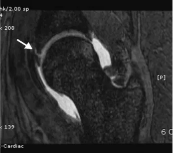 Fig. 5. Conventional MR arthrography of hip can clear- clear-ly reveal acetabular labrum and adjuvant  artic-ular cartilage