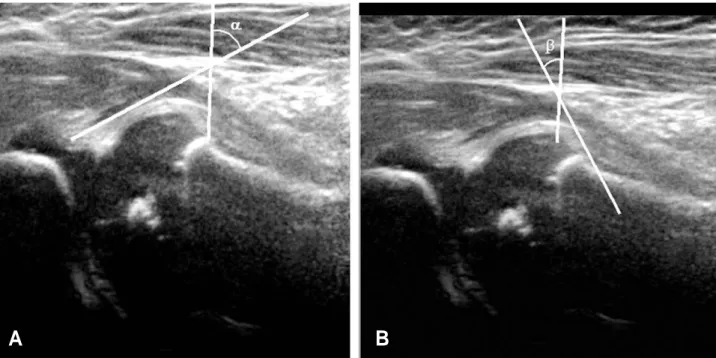 Fig. 9. With sagittal ultrasound image of pediatric hip, dysplastic hip can be classified