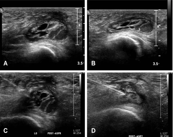 Fig. 10. A 70 year old lady complained pain at buttock when she sits on a hard chair. (A) The ultrasound reveals large soft tissue mass at her ischial area