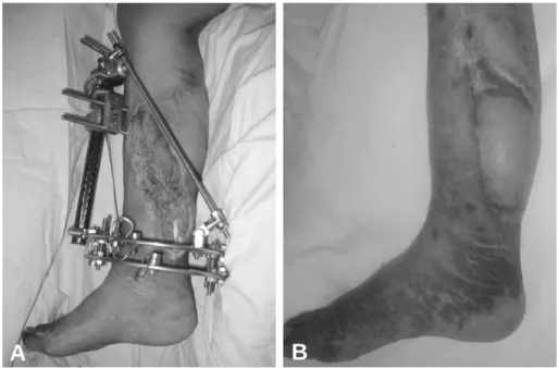 Fig. 2. (A) 55 year-old-man had skin necrosis of left lower leg after skin graft with external fixator