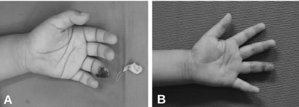 Fig. 3. Case 2. 17-year-old male patient with complete amputation of right ring finger by  car door (Zone I)