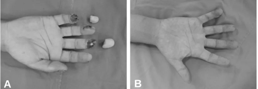 Fig. 4. Case 3. 45-year-old male patient with complete amputation of right middle  &amp; little finger by press (Zone I).