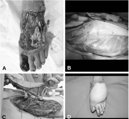 Fig. 2. (A) Preoperative view of a 52 year-old man with the soft tissue defect on the left foot dorsum