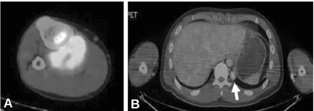 Fig. 3. Histopathologic findings were diagnosed as synovial sarcoma in slide (A) (×100) and (B) (×200).