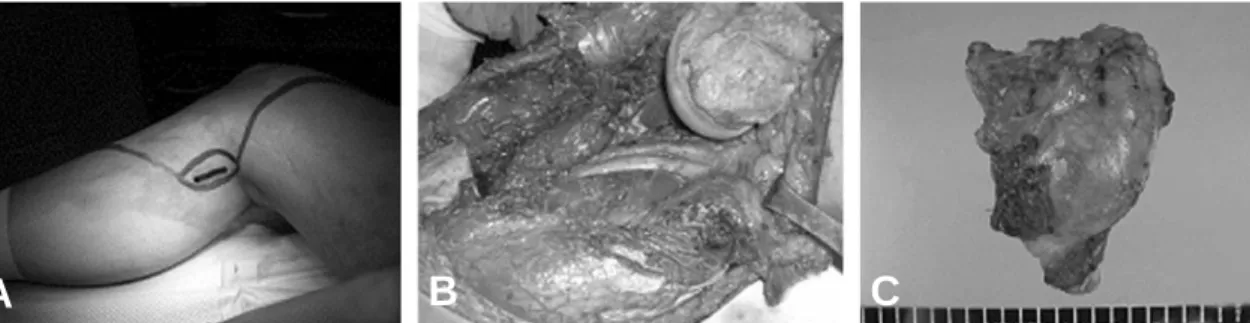 Fig. 6. Simple x-ray shows post operative state of limb salvage surgery with tumor prosthesis.