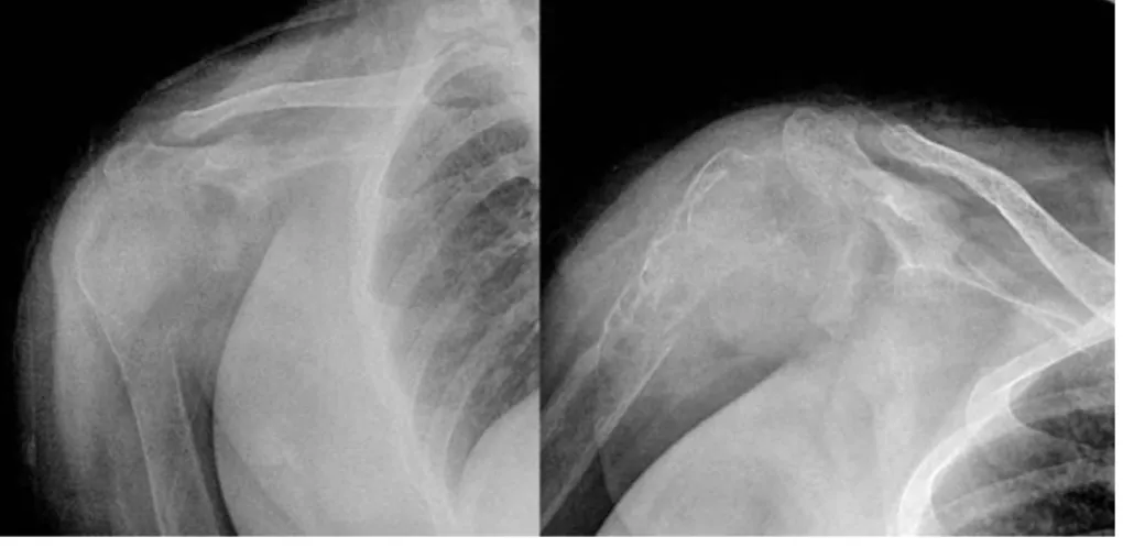 Fig. 1. Initial radiographs of 29 years old woman shows the 5×3 cm sized diffuse osteolytic lesion of right proximal humerus.