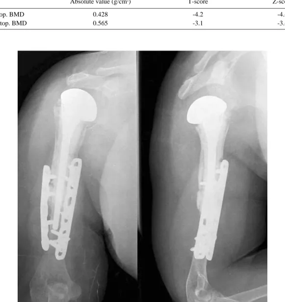 Fig. 5. Last follow up radiographs shows the callus formation and increased bone density of proximal humerus.