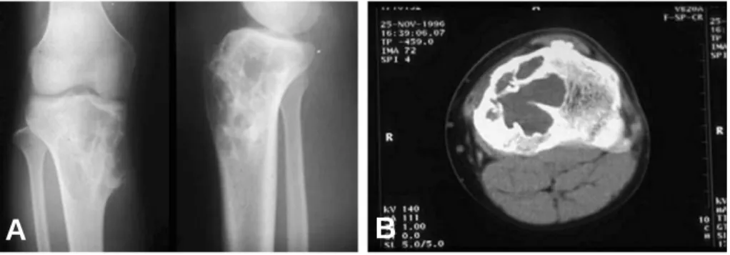 Fig. 1. (A) Anteroposterior and lateral roentgenogram of knee shows osteolytic lesions with multiple cytic lesions on proximal tibia