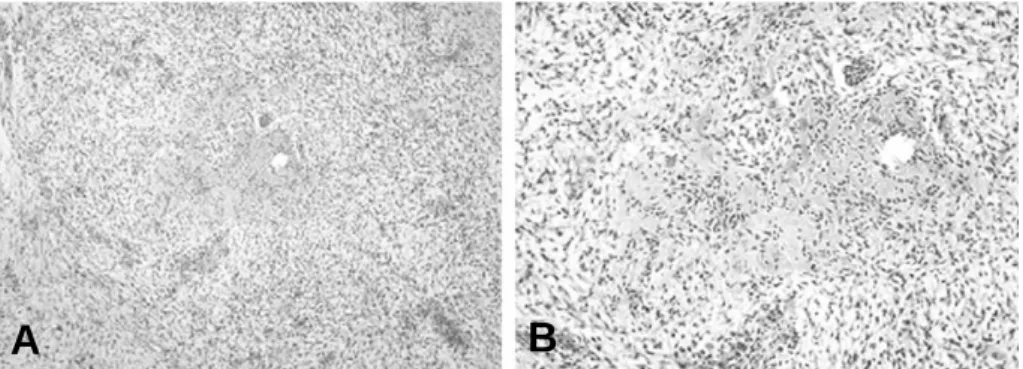 Fig. 5. Whole body bone scan after curettage. It shows heterogenously increased bony uptake in the left proximal tibia