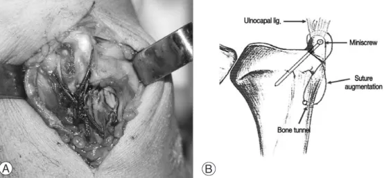 Fig. 1. A clinical photograph and a diagram of miniscrew fixation with figure of 8 tension-band suture augmentation.