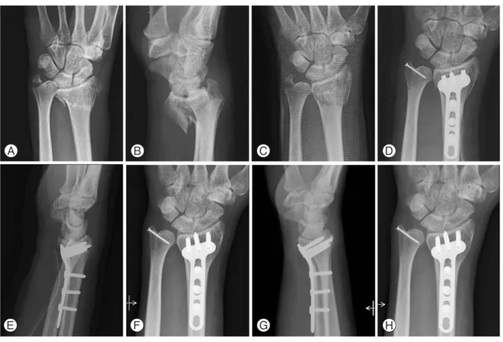 Fig. 2. A case (No 9) of intra-articular distal radius fracture with ulnar styloid avulsion