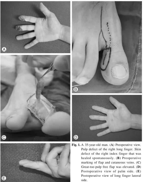 Fig. 1. A 35-year-old man. (A) Preoperative view.