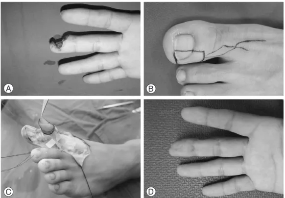 Table 1. Data of patients with free toe-pulp transfer No. of