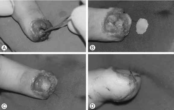 Fig. 1. Operative procedures of immediate nail bed graft with flap in acute fingertip injury with nail bed defect