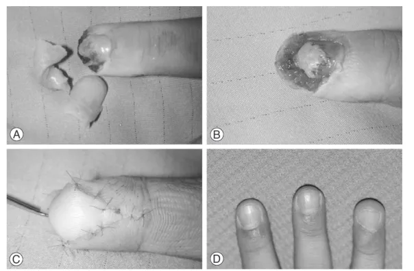 Fig. 3. Case 2. A 35-year-old man was injured by saw machine in right long fingertip. (A) Preoperative view