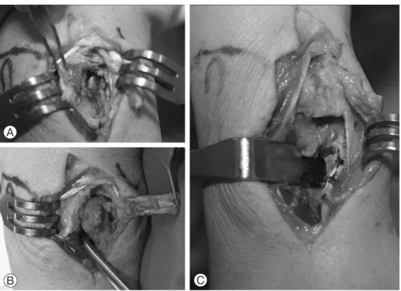 Fig. 5. Intraoperative findings. (A) Joint was approached between extensor digiti minimi and extensor carpi ulnaris