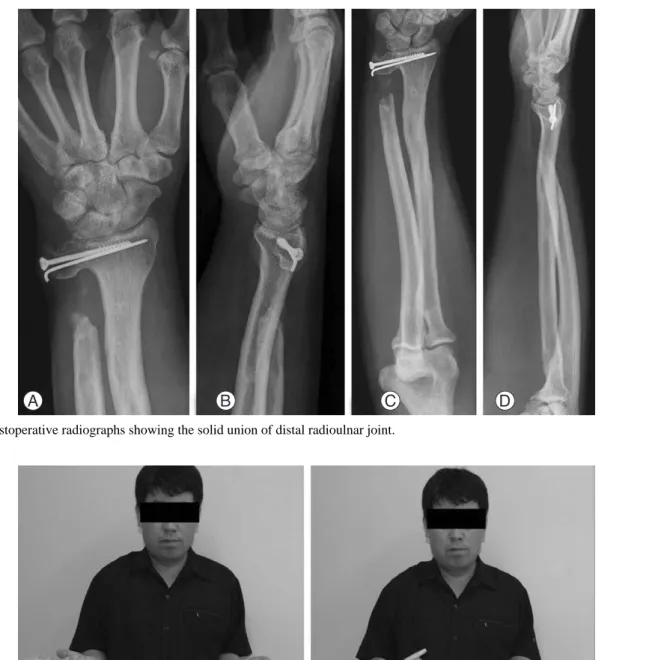 Fig. 7. Postoperative range of motion of forearm rotation.