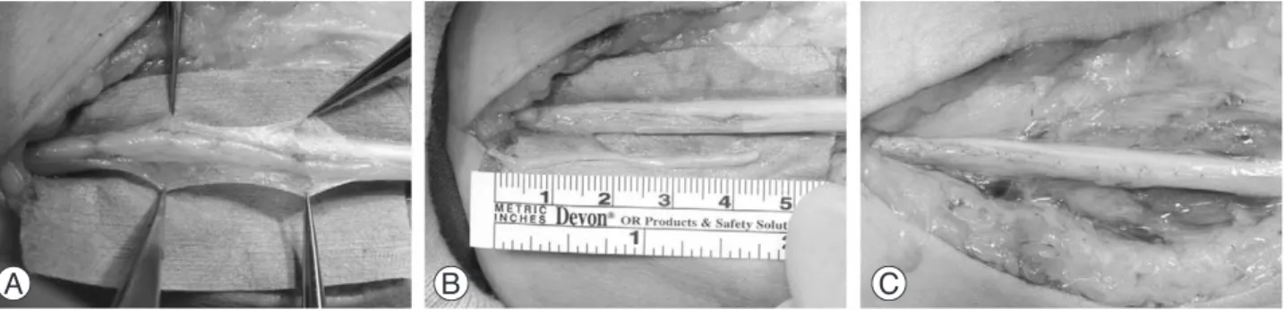 Fig. 2. Multiple hourglass-like constrictions of median nerve at upper arm were seen (A)