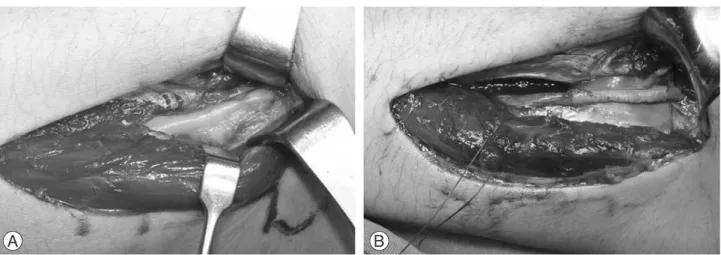 Fig. 4. Hourglass-like constriction of posterior interosseous nerve (PIN) was found (A)