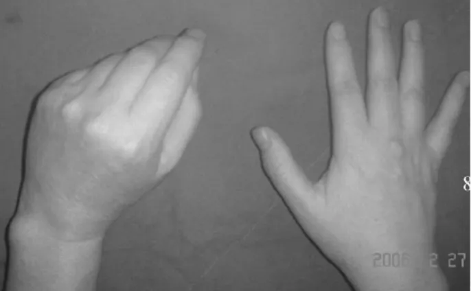 Fig. 1. A preoperative photo showed a typical presentation of PIN palsy.