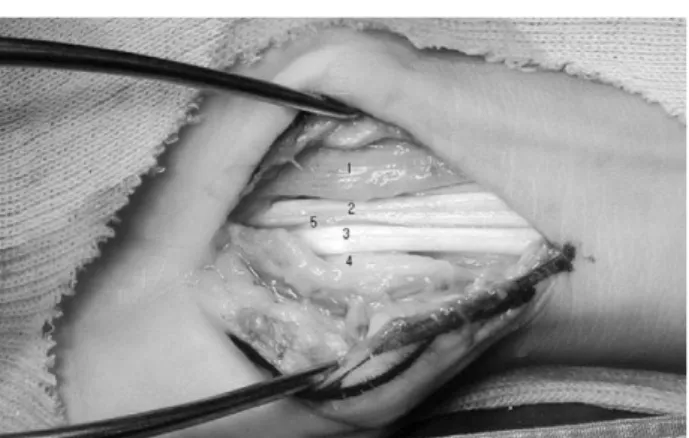 Fig. 1. 4 th flexor digitorum superficialis tendon is dislocated to inferior of resected transcarpal ligament and medial to the hook of hamate, and as a result it is compressing distal ulnar tunnel at anteromedial side (1-median nerve, 2-flexor digitorum p