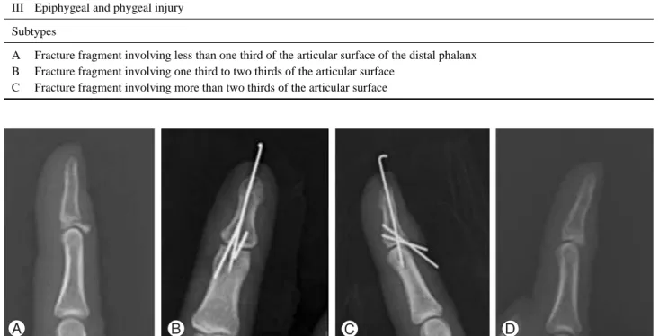 Fig. 1. A 18 year old female patient had bony mallet finger injury. (A) The initial lateral X-ray showed a displaced dorsal fragment and articular involvement more than 30% without subluxation