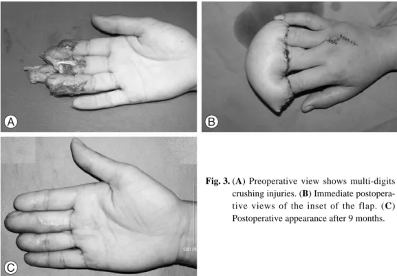 Fig. 3. (A) Preoperative view shows multi-digits crushing injuries. (B) Immediate  postopera-tive views of the inset of the flap