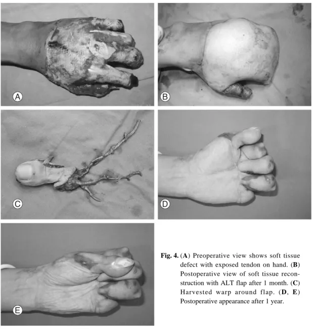 Fig. 4. (A) Preoperative view shows soft tissue defect with exposed tendon on hand. (B) Postoperative view of soft tissue  recon-struction with ALT flap after 1 month