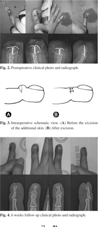 Fig. 3. Intraoperative schematic view. (A) Before the excision of the additional skin
