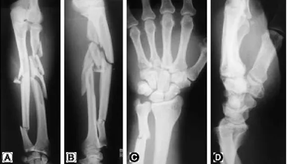 Fig. 1. Initial radiographs of forearm and wrist. (A, B) Radiograph shows severe comminuted fracture on radius proximal shaft &amp;