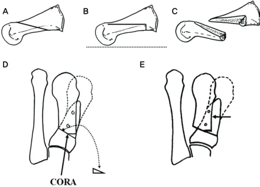 Figure  1.  Diagrammatic  view  of  modified  Mau  osteotomy.  (A)  Original  Mau  osteotomy  (B)  Parallel  cutting  to  the  ground  surface  in  modified  Mau  osteotomy  (C)  Proximal  and  distal  fragments  from  the  modified  cutting  (D)  Final  v